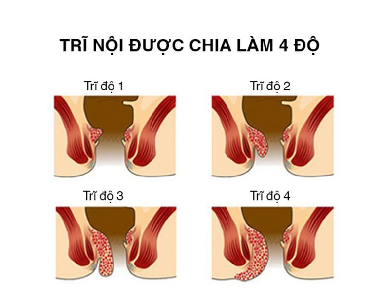 4 cấp độ bệnh trĩ