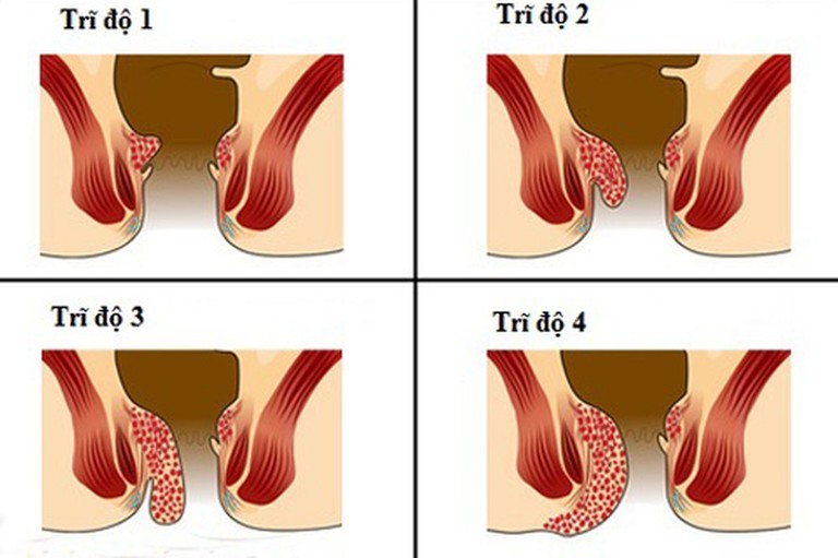 4 cấp độ bệnh trĩ