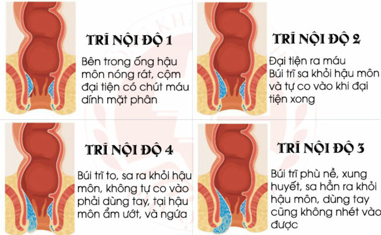 Trĩ nội phân thành 4 cấp độ. Trong đó, từ cấp độ 3 trở lên có thể phải phẫu thuật nếu muốn khỏi bệnh hoàn toàn