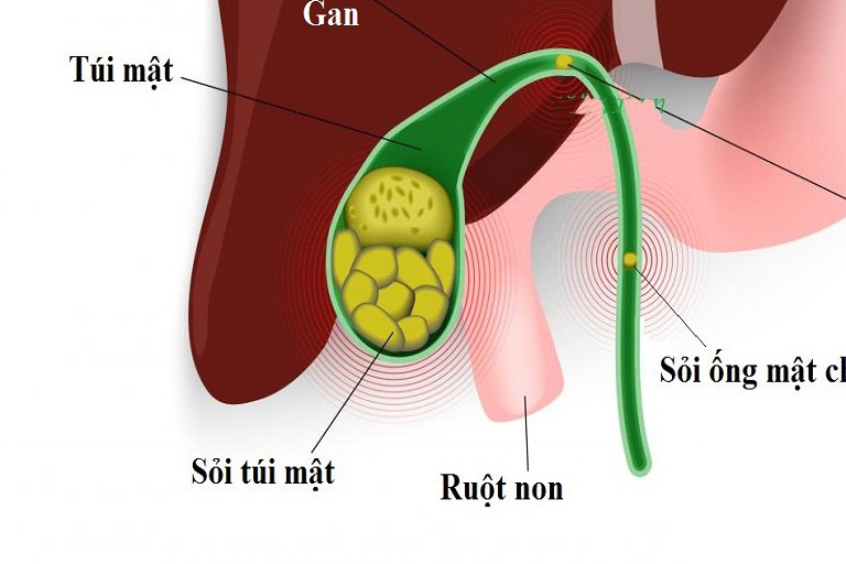 ăn vào buồn nôn