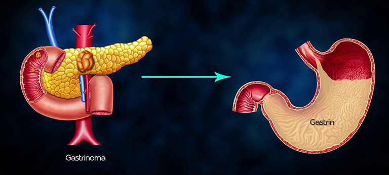 Bà bầu bị nóng rát dạ dày