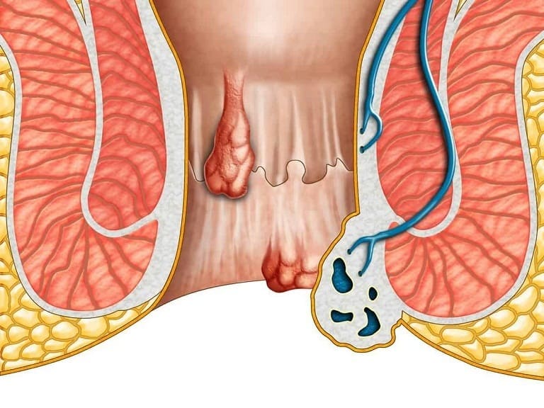 Bà bầu có cắt trĩ được không hay phải đợi sau sinh?