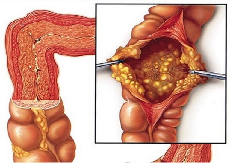 chữa viêm đại tràng bằng mật lợn