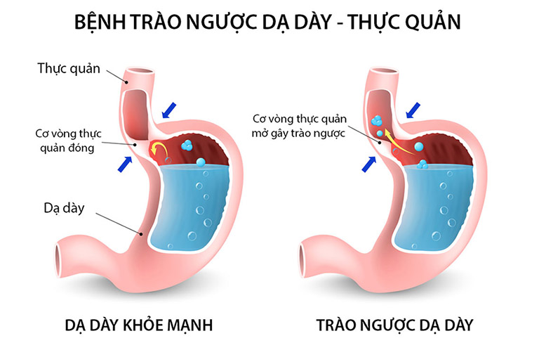 bài thuốc Đông y chữa trào ngược dạ dày