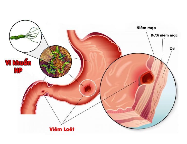 70% người Việt Nam có nguy cơ bị đau dạ dày