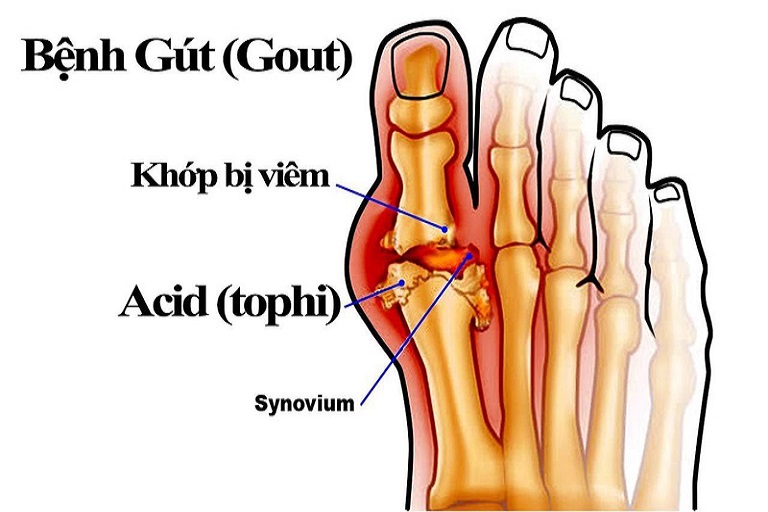 bệnh gút sống được bao lâu