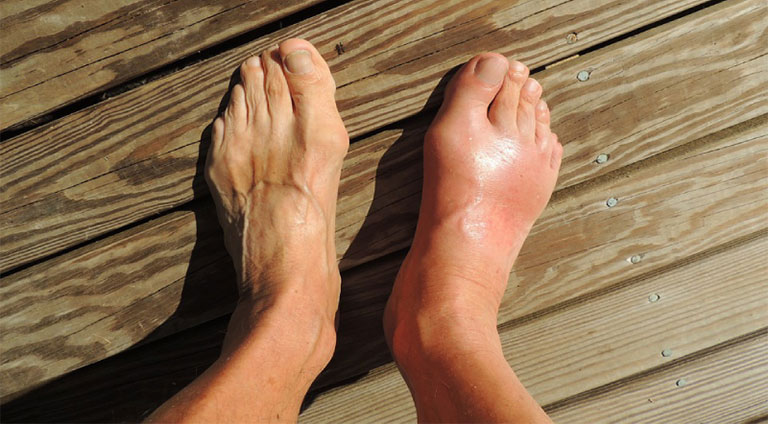 bệnh gout cấp