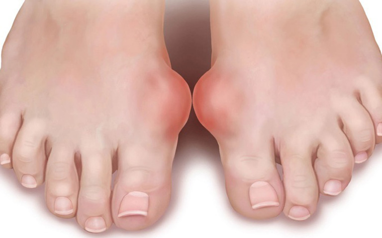 biến chứng bệnh gout ở phụ nữ