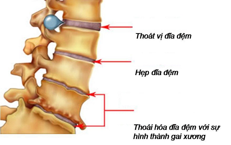 Thoái hóa cột sống lưng