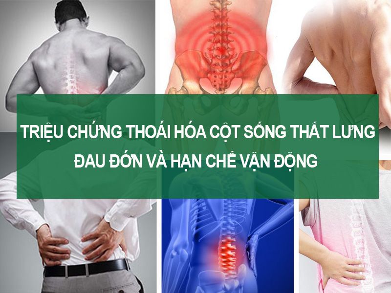 Triệu chứng thoái hóa cột sống thắt lưng