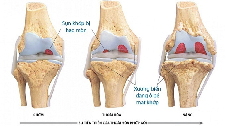 Bệnh thoái hóa khớp gối có chữa được không?