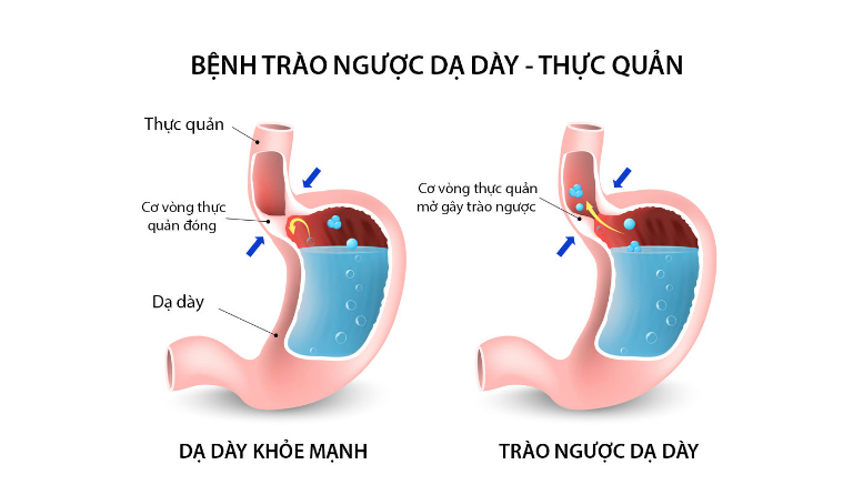 Trào ngược dạ dày thực quản là tình trạng thức ăn, hơi, axit trong dạ dày trào ngược lên thực quản, gây khó chịu, tổn thương niêm mạc thực quản.