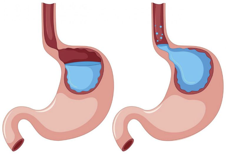 Trào ngược dạ dày thực quản có thể gây ra những biến chứng nguy hiểm khôn lường.