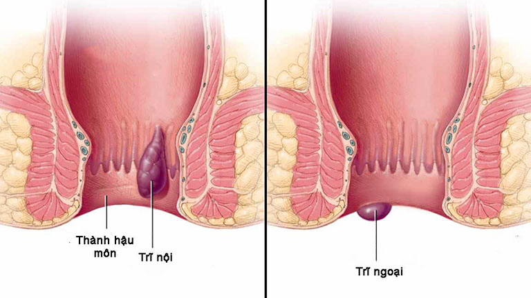 bệnh trĩ có di truyền không