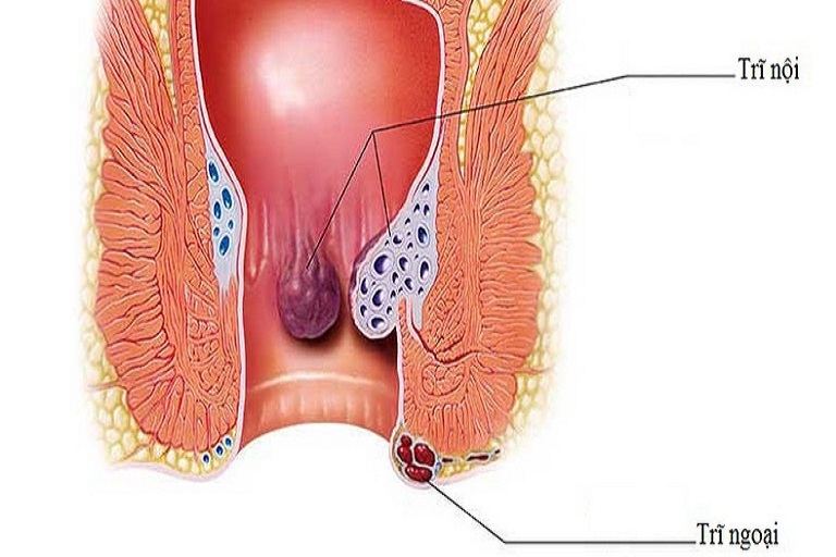 bệnh trĩ để lâu có nguy hiểm không