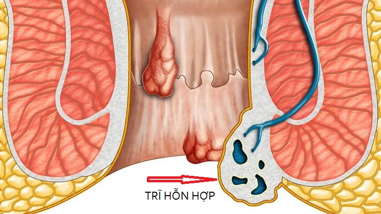 Bệnh trĩ hỗn hợp là gì