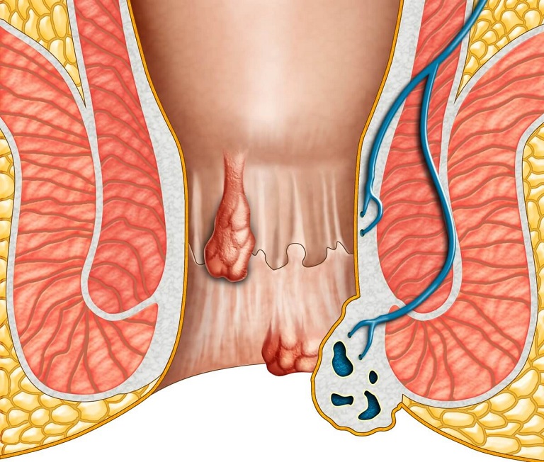 bệnh trĩ nên tập môn thể thao nào