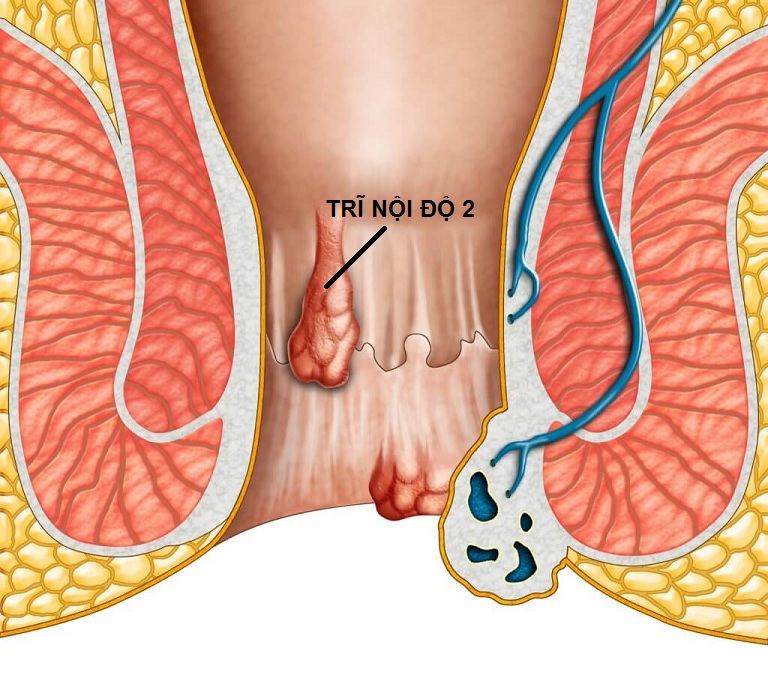 bệnh trĩ nội độ 2