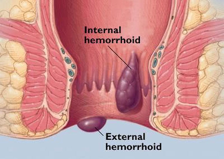 bệnh trĩ tên tiếng anh là gì