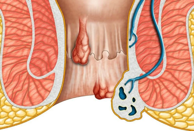 Búi trĩ sưng đau sẽ gây ra những ảnh hưởng đối với cuộc sống của người bệnh.