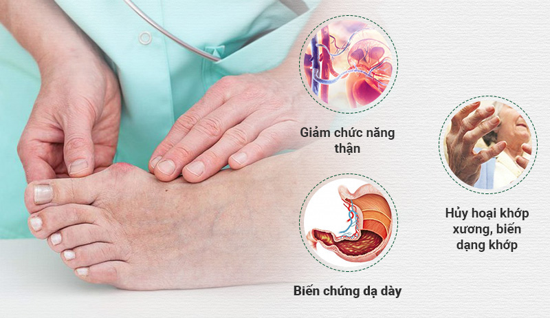 biến chứng nguy hiểm của bệnh gout