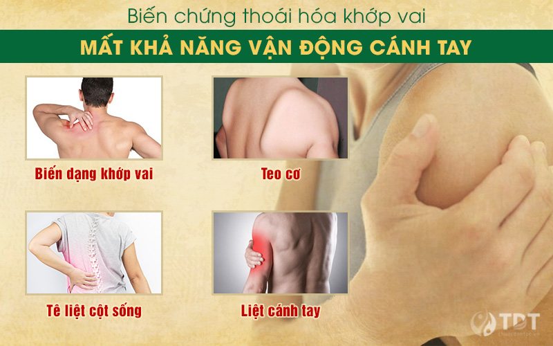 Biến chứng của bệnh thoái hóa khớp vai