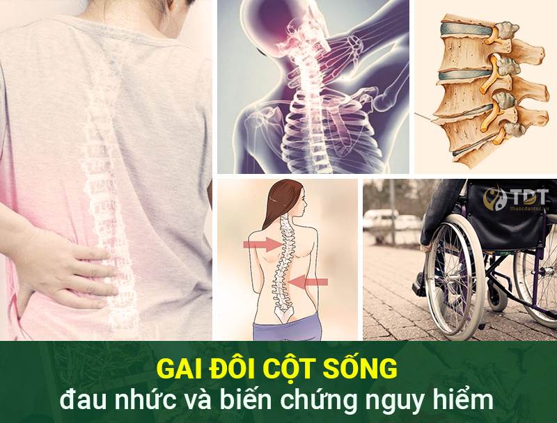 biến chứng của Gai đôi cột sống