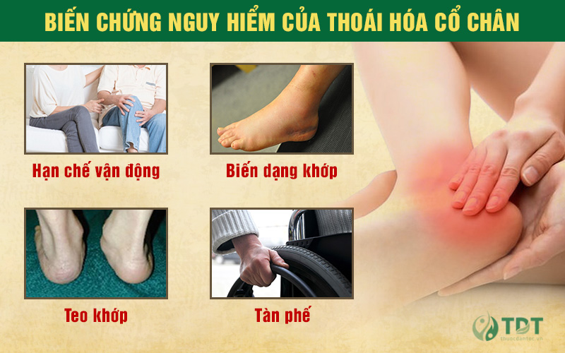 biến chứng nguy hiểm của bệnh thoái hóa cổ chân