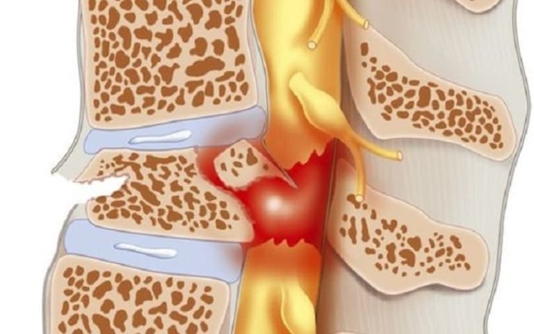 Các biến chứng sau mổ thoát vị đĩa đệm