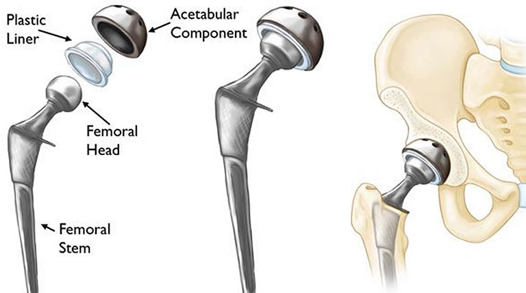 biến chứng sau thay khớp háng
