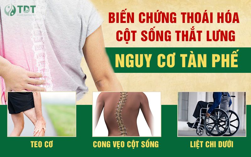 Biến chứng thoái hóa cột sống thắt lưng