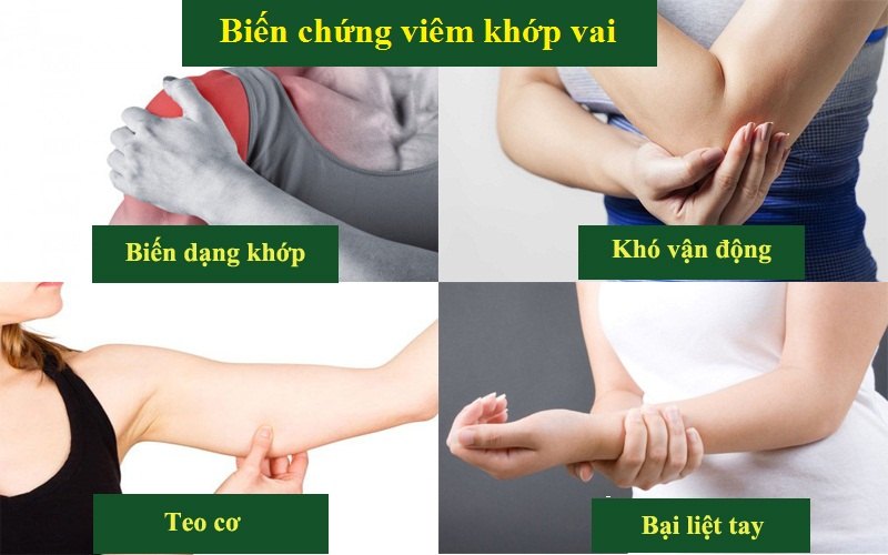 Biến chứng bệnh viêm khớp vai