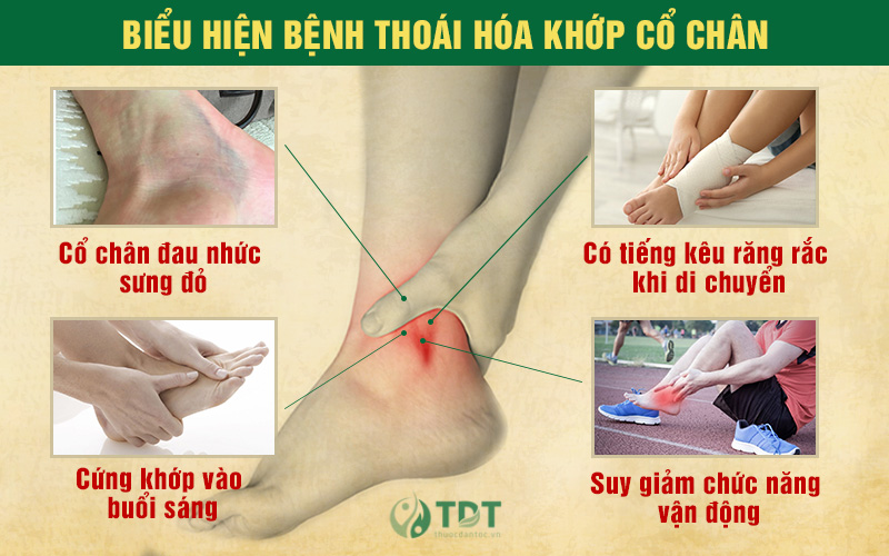 Triệu chứng bị thoái hóa cổ chân