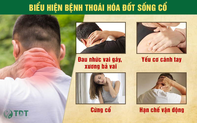 Triệu chứng của bệnh thoái hóa đốt sống cổ