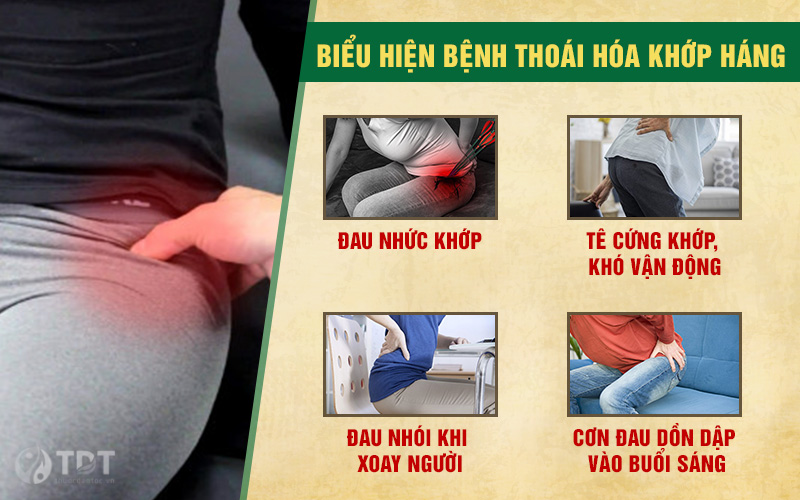 Triệu chứng của bệnh thoái hóa khớp háng