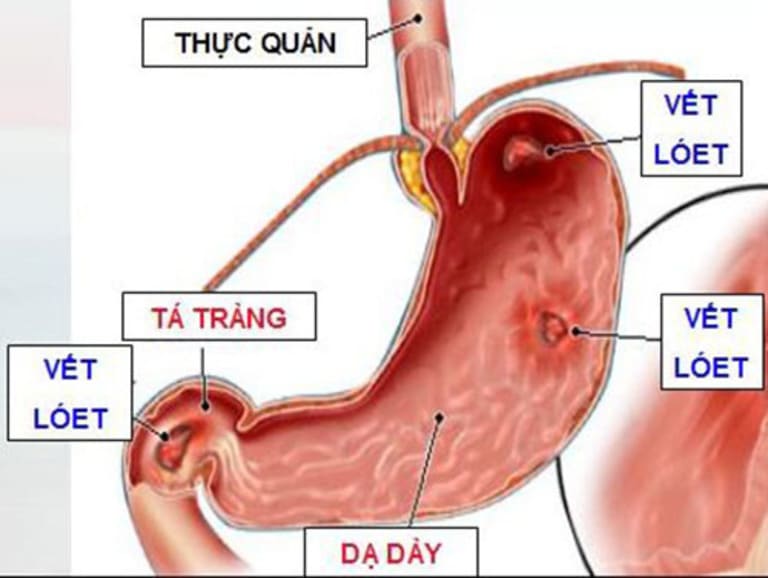 Biểu hiện Hội chứng dạ dày tá tràng