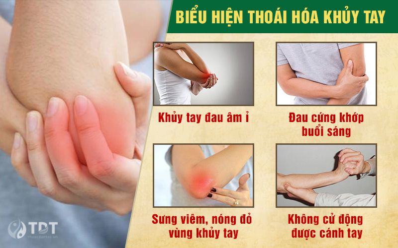 Triệu chứng thoái hóa khủy tay