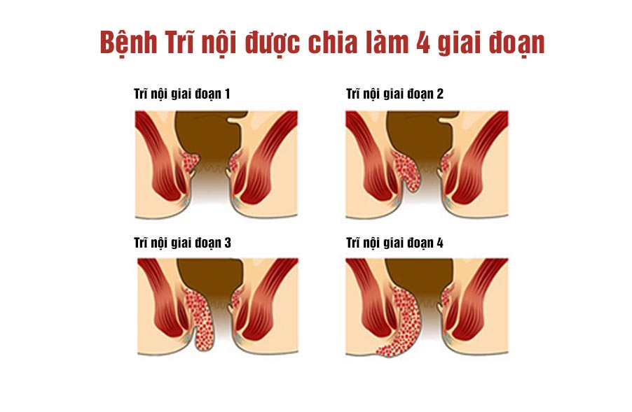 triệu chứng của bệnh trĩ nội