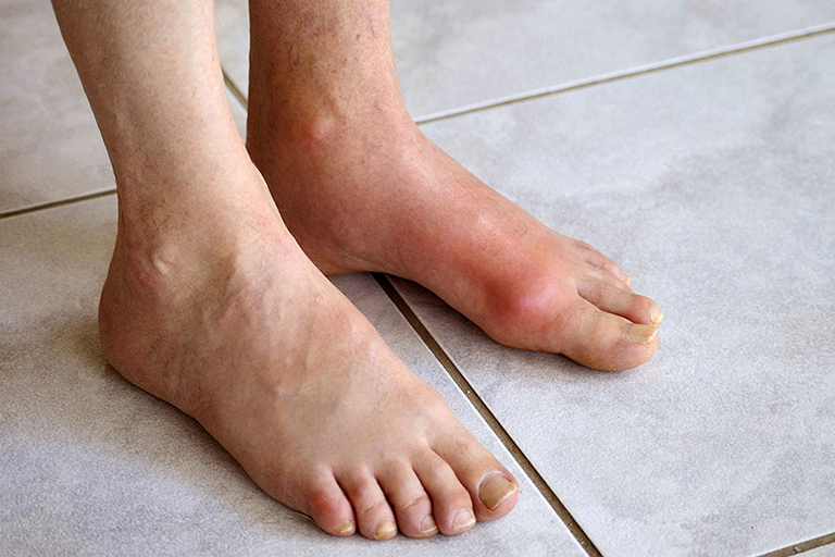 làm bữa sáng cho người bệnh gout