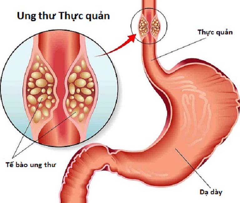 buồn nôn do trào ngược dạ dày