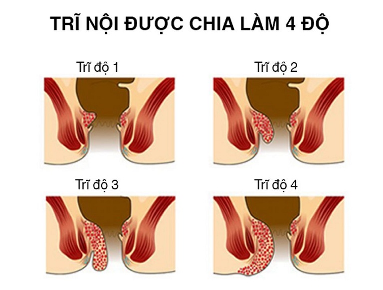 các cấp độ của bệnh trĩ nội