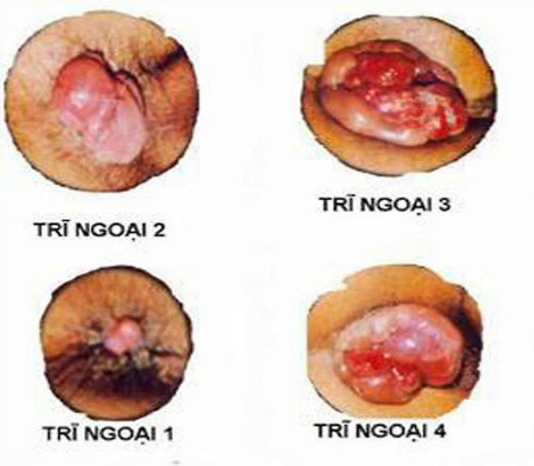 các cấp độ của bệnh trĩ ngoại