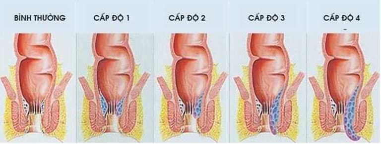 Các giai đoạn phát triển của bệnh trĩ