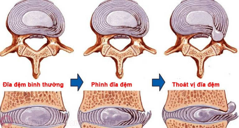 Các giai đoạn thoát vị đĩa đệm và điều cần biết