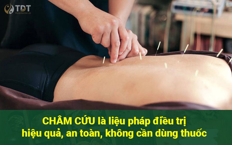 Ưu điểm của châm cứu chữa đau vai gáy