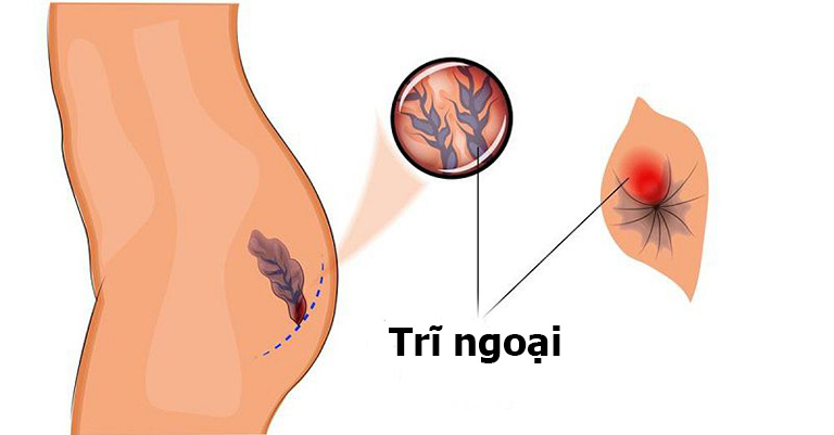 Cách điều trị bệnh trĩ ngoại