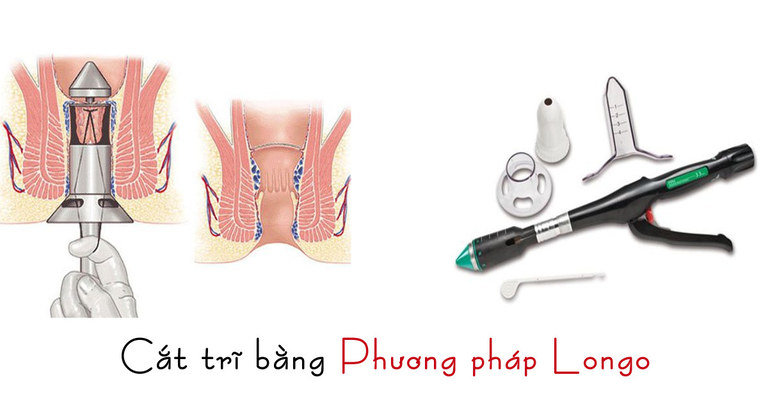 Phương pháp Longo đang được rất nhiều cơ sở y tế sử dụng cắt trĩ hiện nay