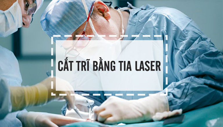 Cắt trĩ bằng tia laser là phương pháp được áp dụng khá phổ biến, mang lại hiệu quả điều trị cao