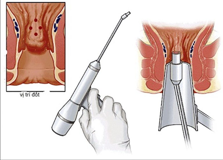 Cắt trĩ bằng sóng cao tân HCPT hoạt động theo phương thức xâm lấn tối thiểu