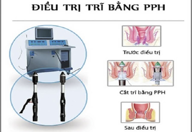 Phương pháp cắt trĩ PPH cắt bỏ đi lớp niêm mạc bị sa và khâu lại, tạo hình hậu môn bên ngoài